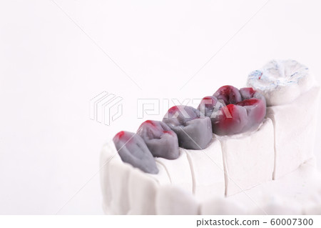 Dental Prosthesis work. Artificial tooth, prosthetic, false teeth 60007300
