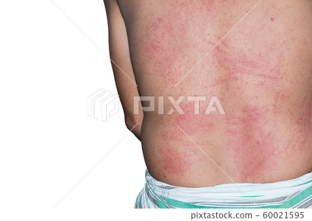 Closeup texeure skin of Urticaria Closeup texeure skin of Urticaria 60021595