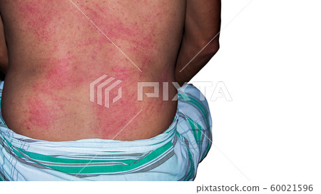 Closeup texeure skin of Urticaria Closeup texeure skin of Urticaria 60021596