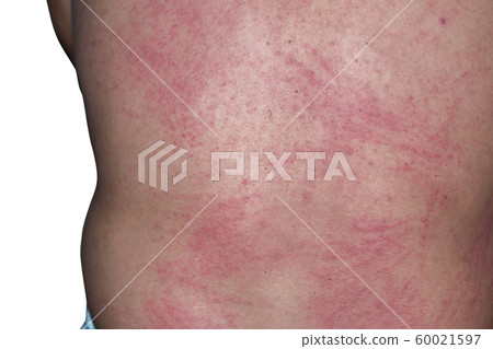 Closeup texeure skin of Urticaria Closeup texeure skin of Urticaria 60021597