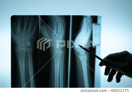 X ray film with doctor's hand to examine X ray film with doctor's hand to examine 60022175