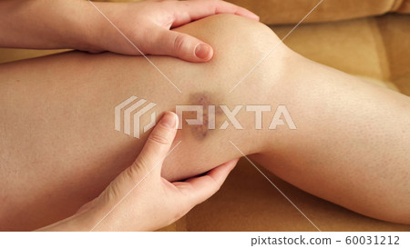 Bruise on the leg of a woman sitting on the couch 60031212