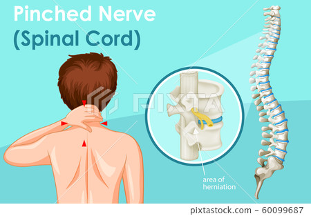 Diagram showing pinched nerve in human - Stock Illustration [60099687 ...