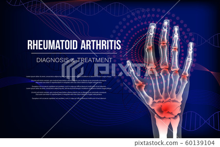 Rheumatoid arthritis osteoarthritis banner inflammation joints of bones of hand. Rheumatoid arthritis osteoarthritis banner inflammation joints of bones of hand. 60139104