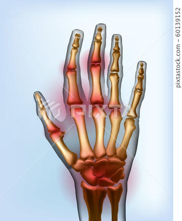Frontal view image sore osteoarthritis joints of bones the of hand. Frontal view image sore osteoarthritis joints of bones the of hand. 60139152