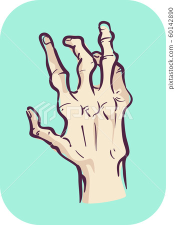 Hands Symptom Joint Deformity Illustration 60142890