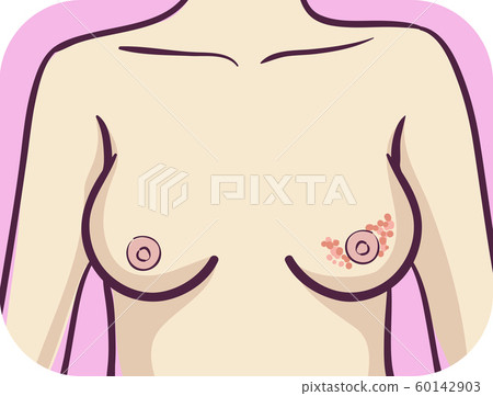Girl Breast Rash Illustration Girl Breast Rash Illustration 60142903