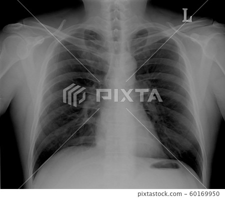 Chest tomography,X-ray of a human to find the disorder of the lungs. Photo tomography pulmonary tuberculosis patients.. 60169950
