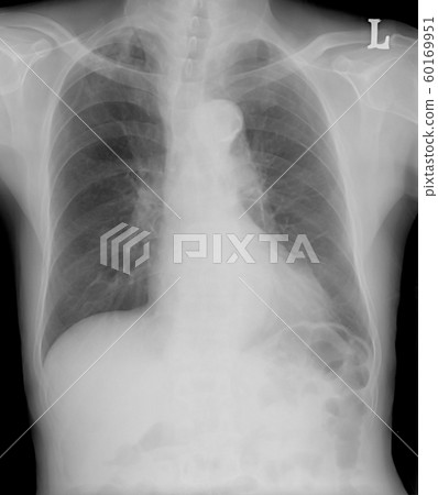 Chest tomography,X-ray of a human to find the disorder of the lungs. Photo tomography pulmonary tuberculosis patients.. Chest tomography,X-ray of a human to find the disorder of the lungs. Photo tomography pulmonary tuberculosis patients.. 60169951
