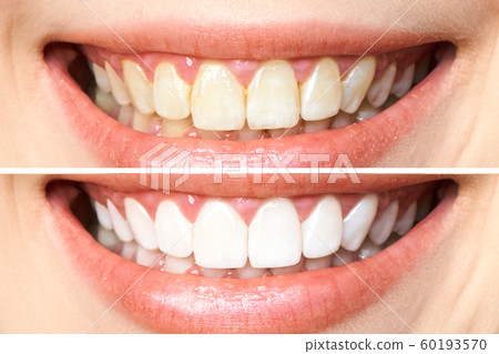 woman teeth before and after whitening. Over white background. Dental clinic patient. Image symbolizes oral care dentistry, stomatology woman teeth before and after whitening. Over white background. Dental clinic patient. Image symbolizes oral care dentistry, stomatology 60193570