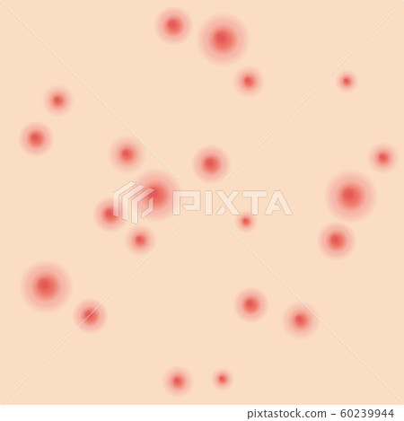 Acne pimples type Acne pimples type 60239944