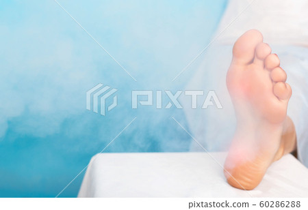 Treatment of warts on the sole of the foot and corns with liquid nitrogen and cryotherapy, plantar wart and corns, dermatology