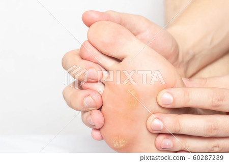 Man shows problem skin on the foot and sole of the foot dry and callous skin with mazols with a stem, close-up, copy space, disease Man shows problem skin on the foot and sole of the foot dry and callous skin with mazols with a stem, close-up, copy space, disease 60287289
