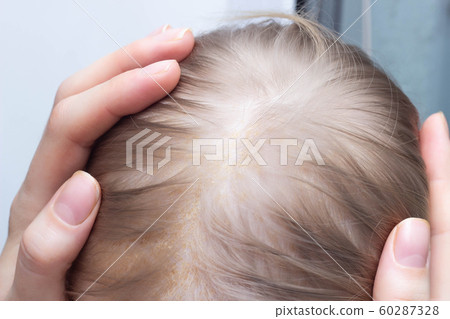 Fungal skin disease seborrheic dermatitis in a child's head, close-up, seborrhea crust, dermatology Fungal skin disease seborrheic dermatitis in a child's head, close-up, seborrhea crust, dermatology 60287328
