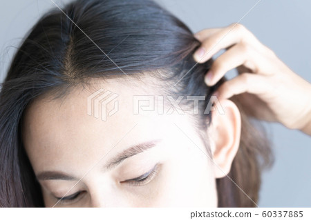 Woman serious hair loss problem for health care 60337885