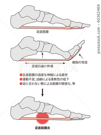 Plantar Fasciitis Foot Bones Foot Muscles Stock Illustration