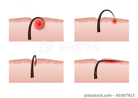 Ingrown hairs after depilation. 60367923