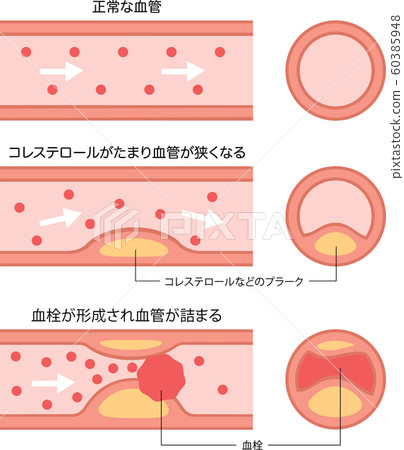 動脈硬化的進展 動脈硬化的進展 60385948