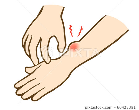 手臂被咬 60425381