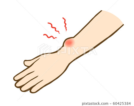 手臂被咬 60425384