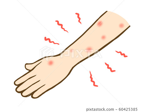 Arm bites 60425385
