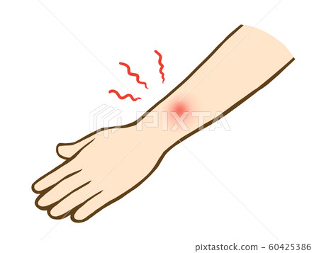Arm bites Arm bites 60425386