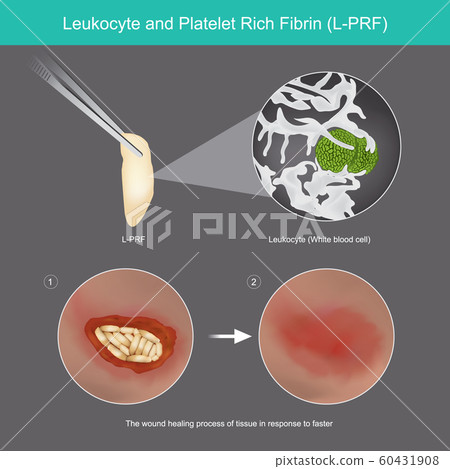 Leukocyte and Platelet Rich Fibrin. Illustration 60431908