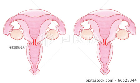 Cervical erosion 60525344