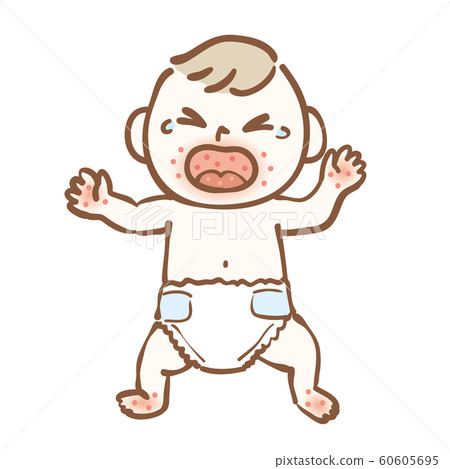 Hand foot and mouth disease baby 60605695