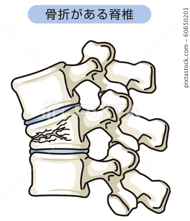 脊柱骨折伴壓迫性骨折 60650201
