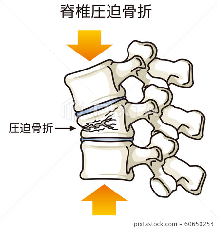 Fractured spine with compression fracture 60650253