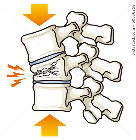 脊柱骨折伴壓迫性骨折 60650258