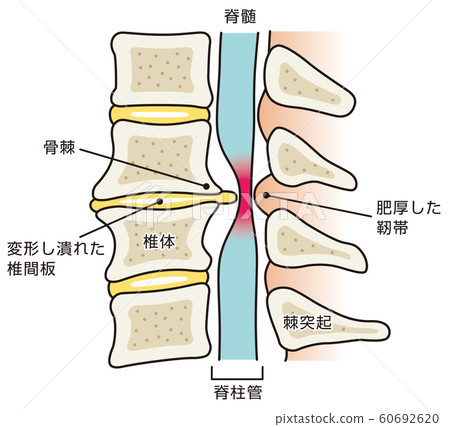 椎間盤突出症醫療 椎間盤突出症醫療 60692620