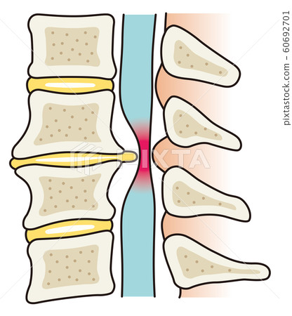 Intervertebral hernia medical 60692701