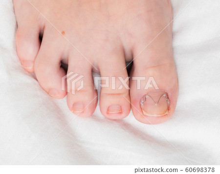 Toenail clamp is mounted on an ingrown toenail 60698378