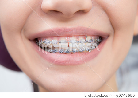 Smiling happy woman mouth with tongue and braces. Orthodontics occlusion correction in dentistry 60745699