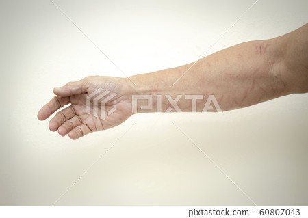 Injury arms 60807043