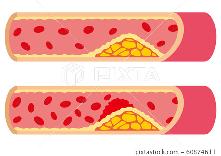 Atherosclerosis blood vessels Atherosclerosis blood vessels 60874611