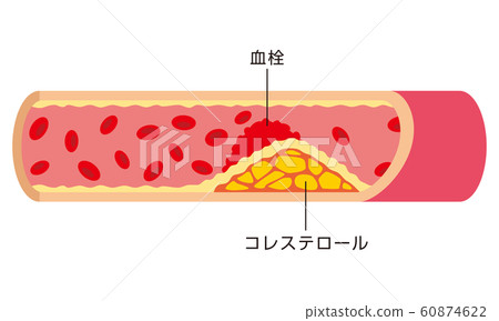 Atherosclerosis blood vessels 60874622