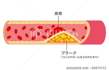 Atherosclerosis blood vessels 60874731