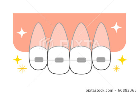 正畸矯治器前牙的圖示 60882363