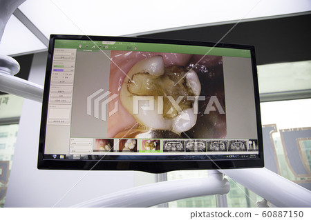 Damaged tooth floating on dental monitor 60887150