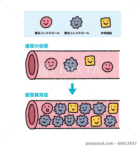 膽固醇中性脂肪好壞動脈硬化圖 60913937