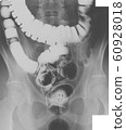 Large intestine radiograph 03 60928018