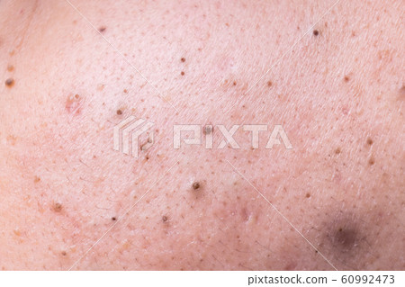Ugly pimples blackheads on face of teenager 60992473