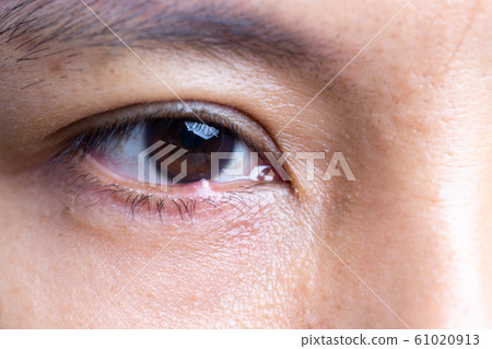 Close up of woman patient's infected eye. .Purulent eyes at right loer eyelid 61020913