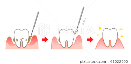 Periodontal disease scaling illustration before and after 61022900