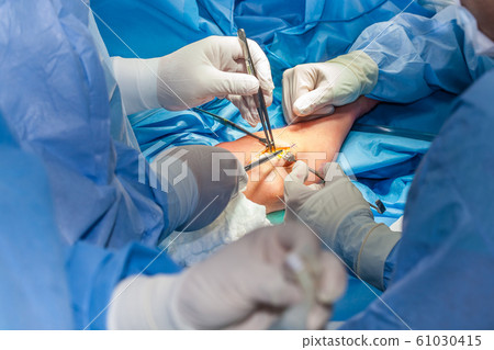 Group of surgeons performing an elbow surgery Group of surgeons performing an elbow surgery 61030415
