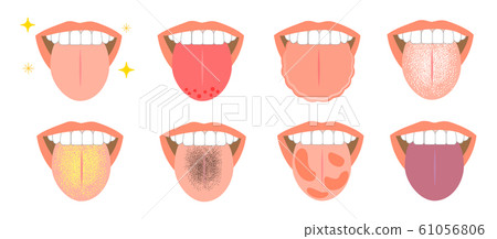 Summary of various symptoms of tongue trouble 61056806