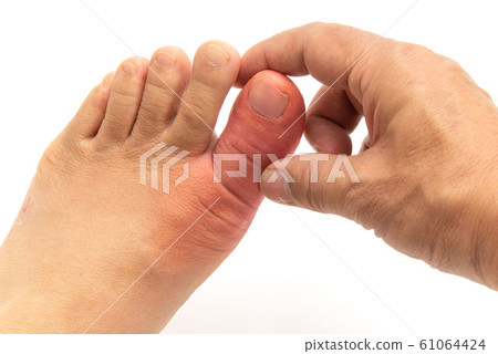 Gouty feet Gouty feet 61064424